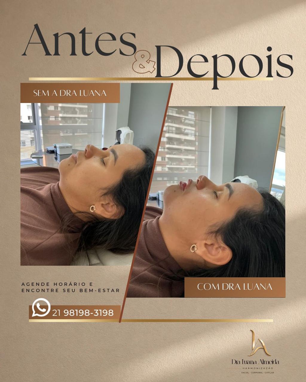 Rejuvenescimento facial — antes e depois