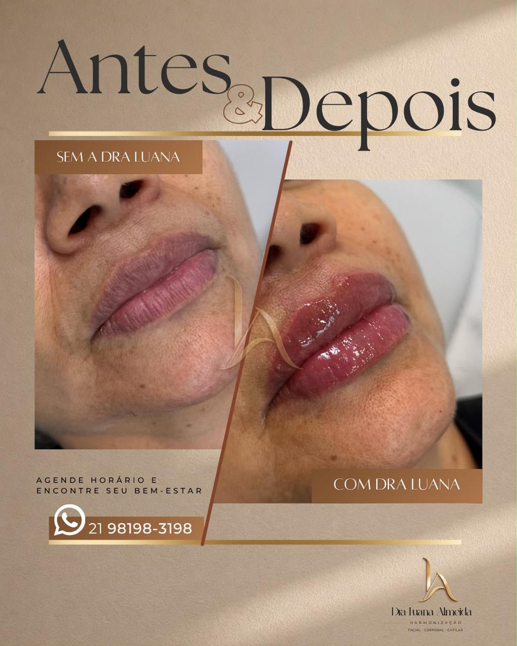 Volume e definição labial — antes e depois