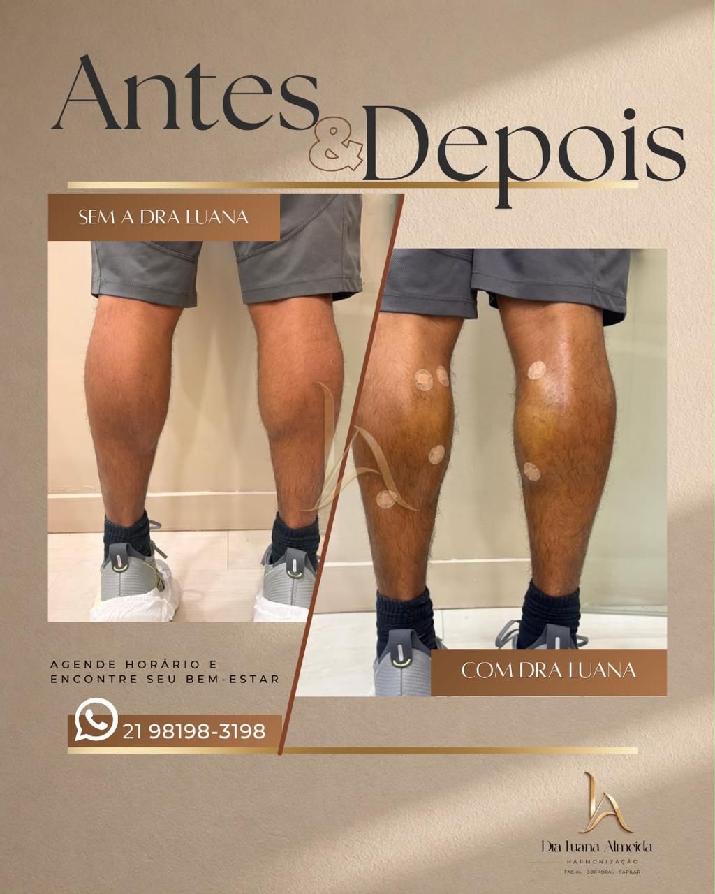 Definição de pernas — antes e depois
