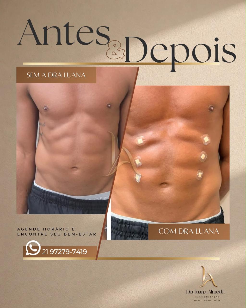 Definição abdominal — antes e depois