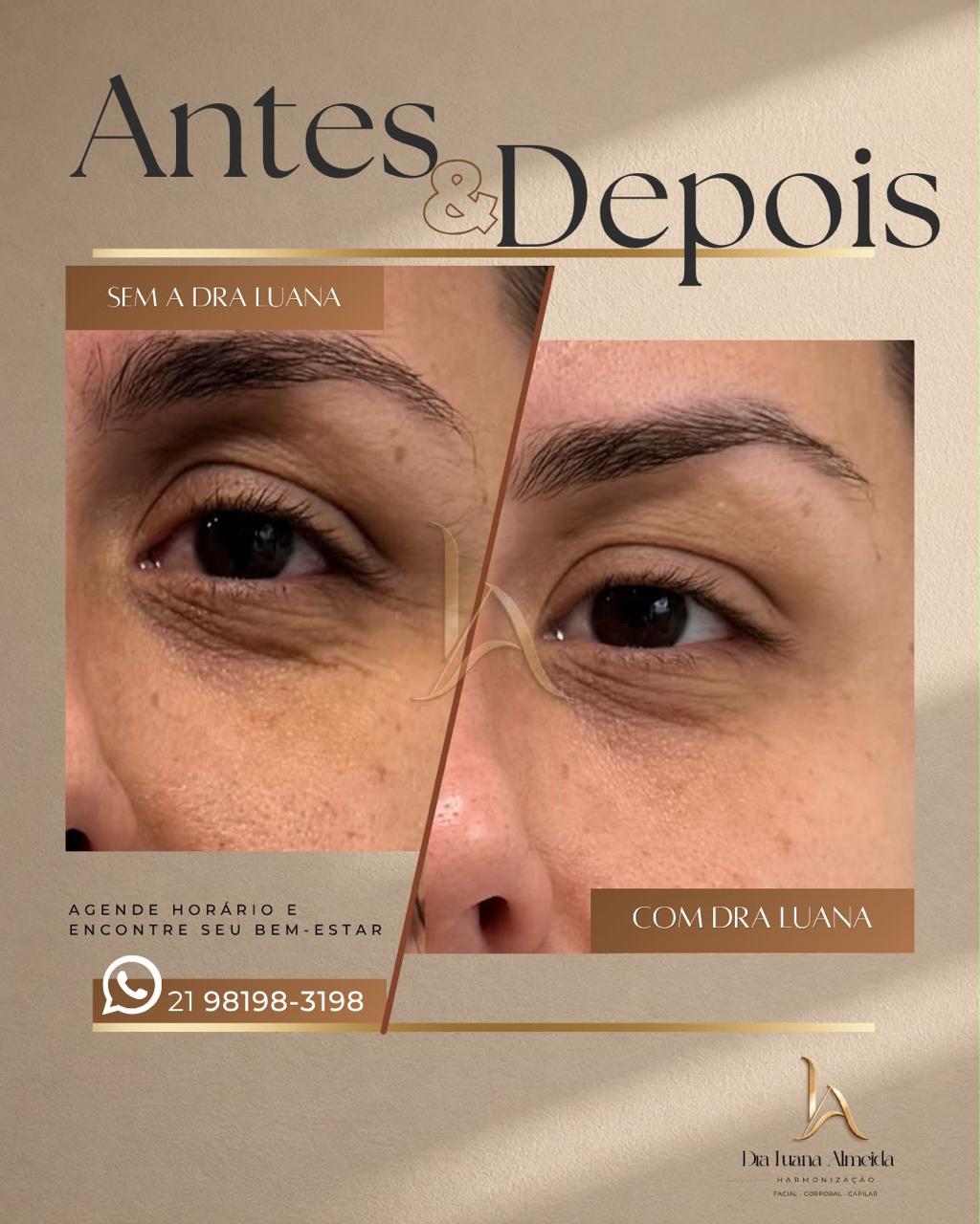 Rejuvenescimento do olhar — antes e depois