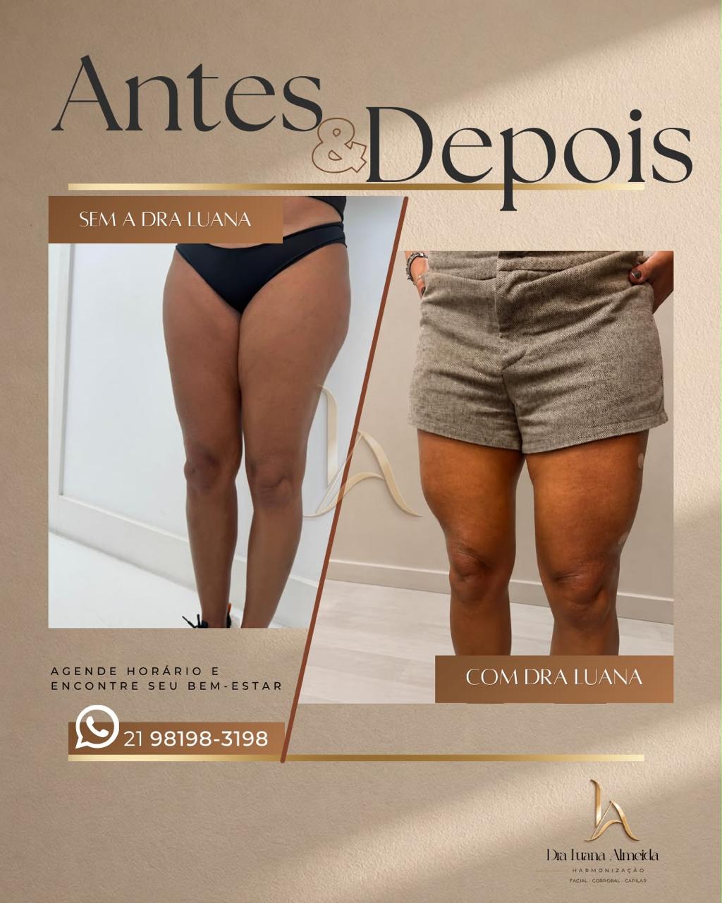 Contorno corporal — antes e depois