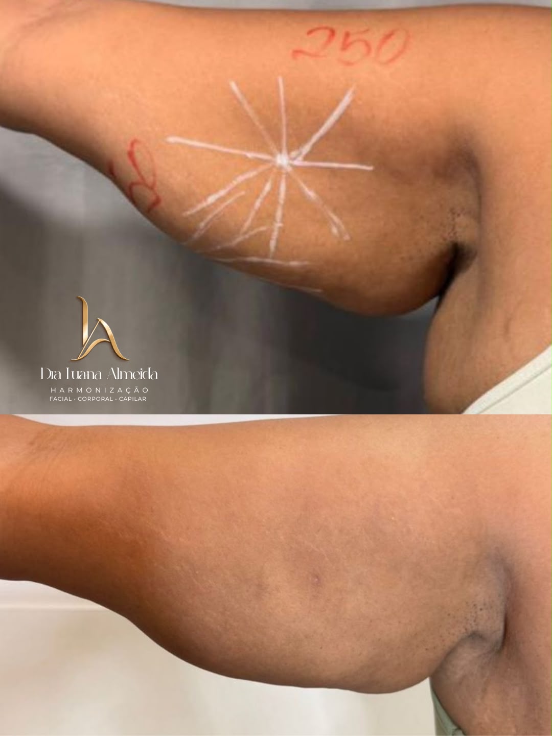 01 Sessão de Endolaser — antes e depois