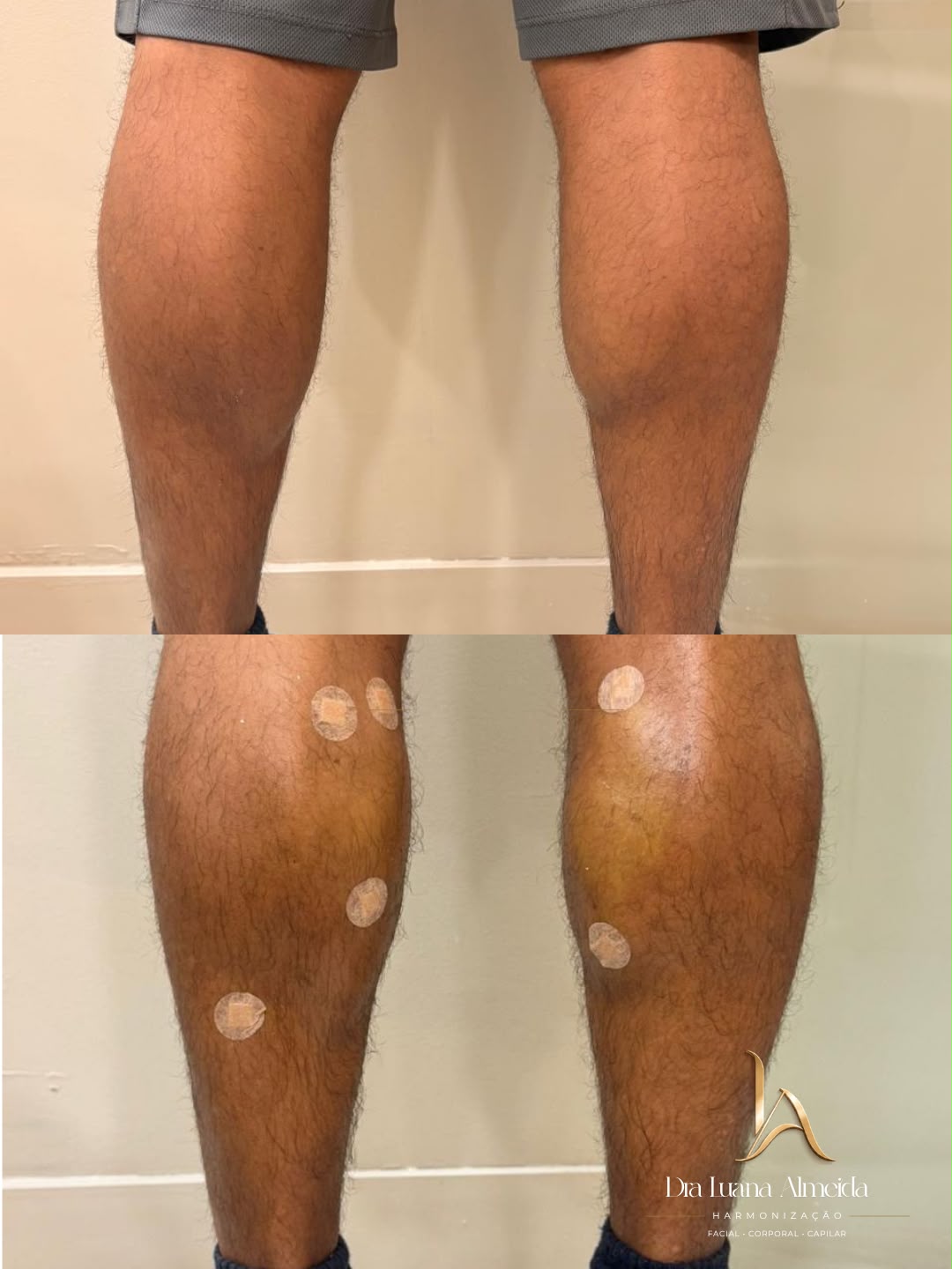 Harmonização de panturrilha — antes e depois