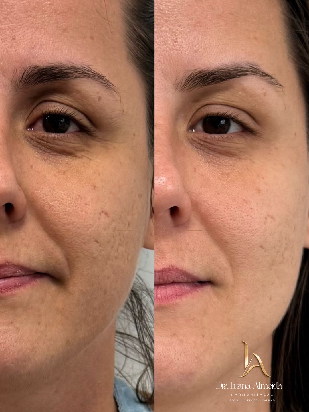 Toxina botulínica para abertura do olhar — antes e depois