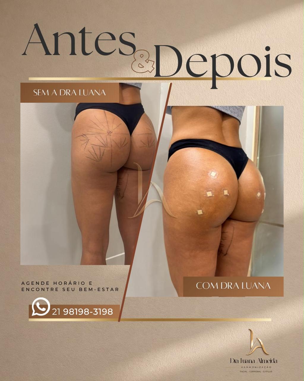 Harmonização glútea — antes e depois