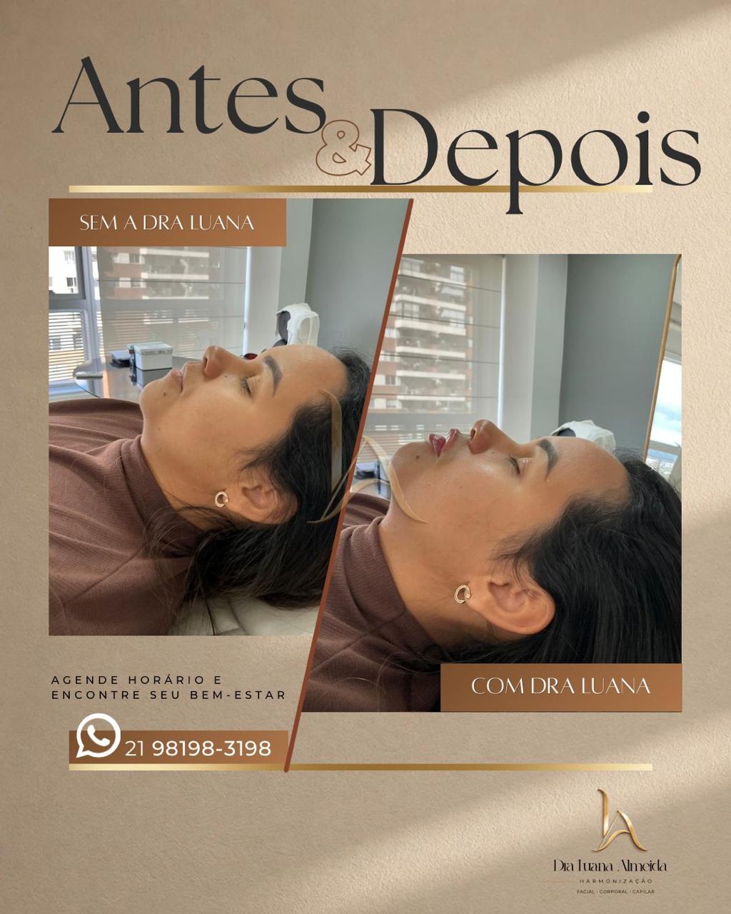 Harmonização facial — antes e depois
