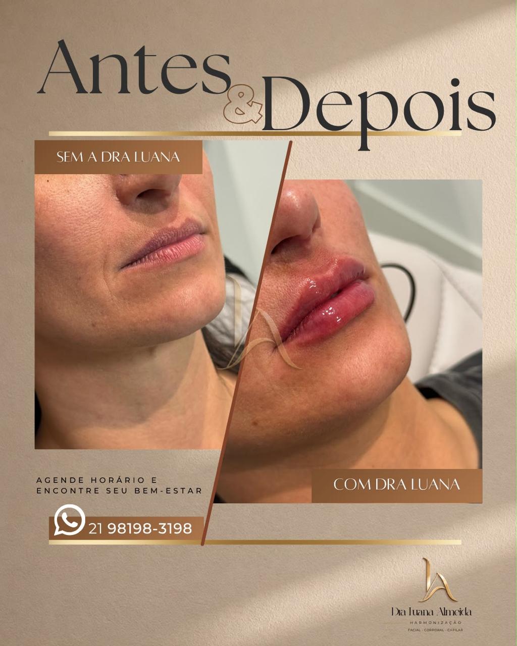 Contorno dos lábios — antes e depois