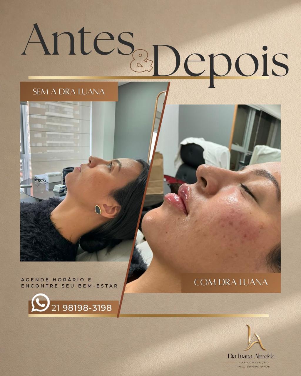 Contorno facial e mandibular — antes e depois