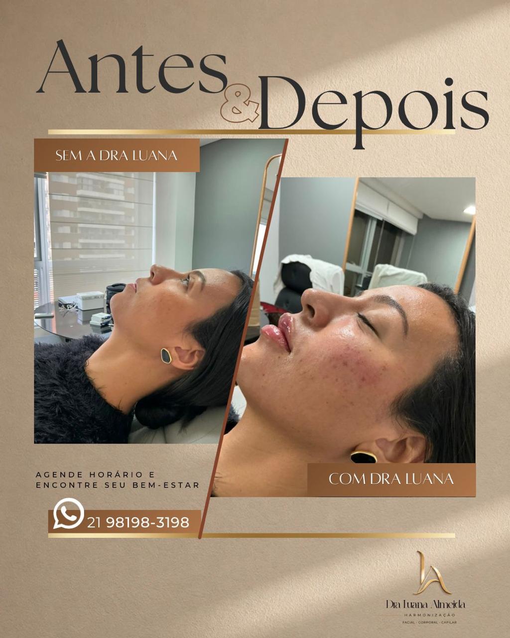 Skinbooster facial — antes e depois